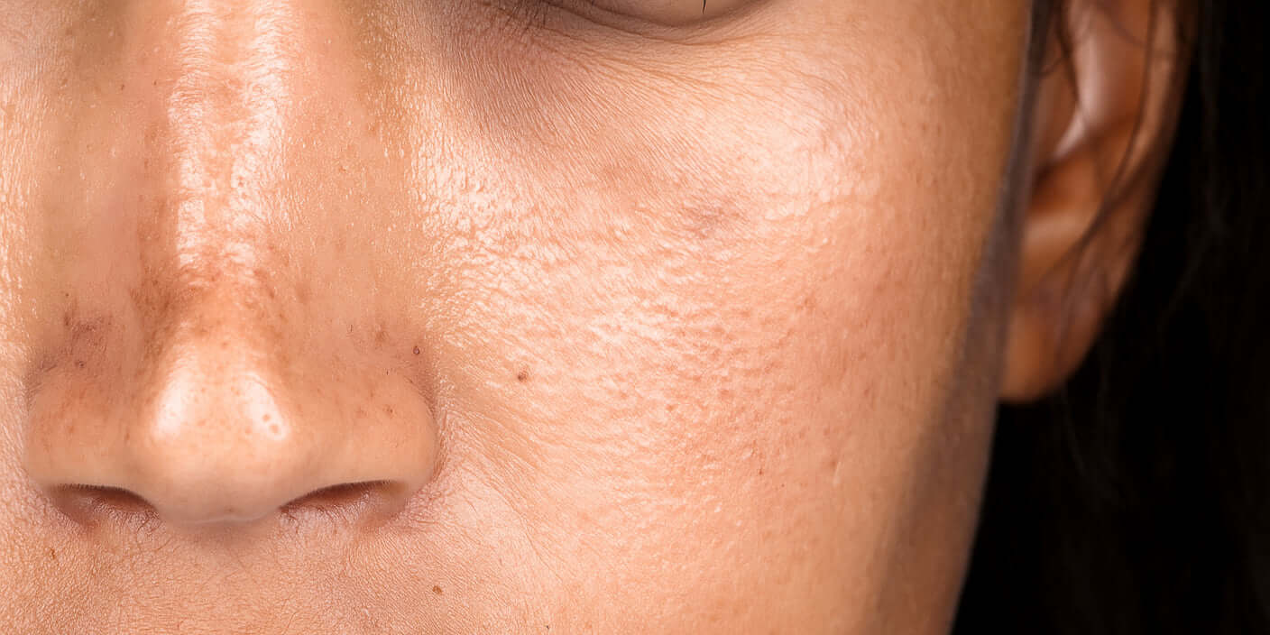 The Best Skincare For Hyperpigmentation Treatment with tips to Heal & Prevent It