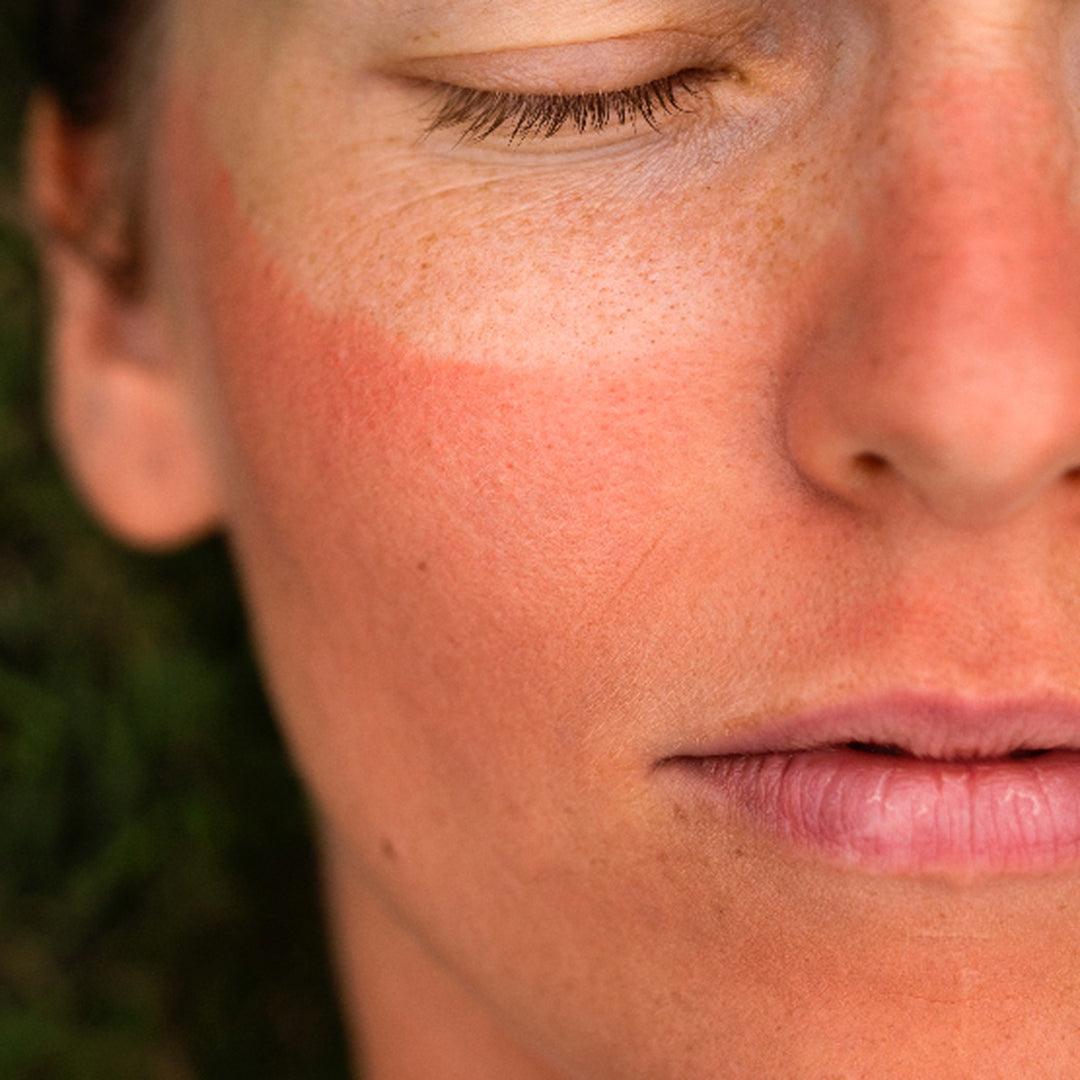 Skin Problem Lotto 5 Common Summer Skin Problems (and How to Solve Them) - Indagare ...